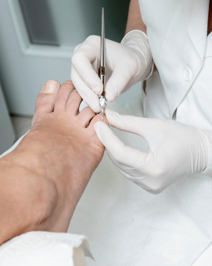 Nagelkorrektur in Walsrode